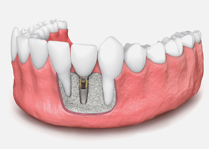 What is a dental implant bone graft?