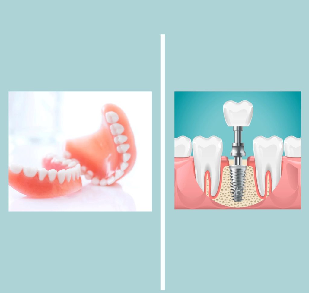 Dentures vs. Dental Implants: Which is Right for You?