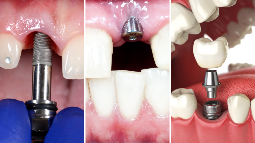 The 3 Steps To Getting A Dental Implant