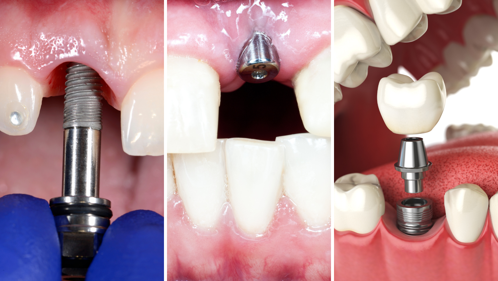 Three steps to getting dental implants