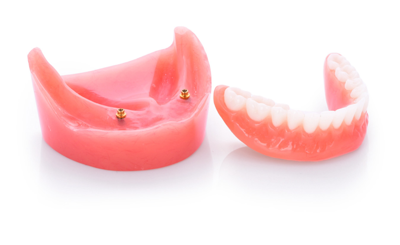 What is a snap-in denture? And is it right for me?