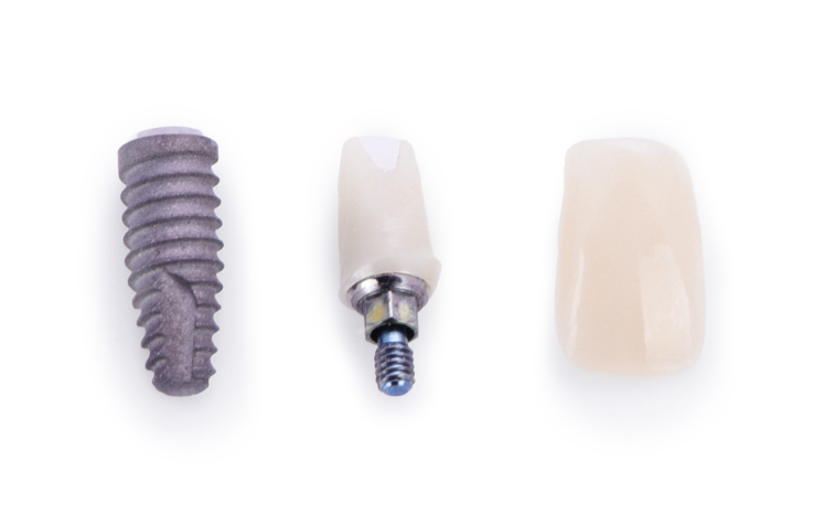 implant examples