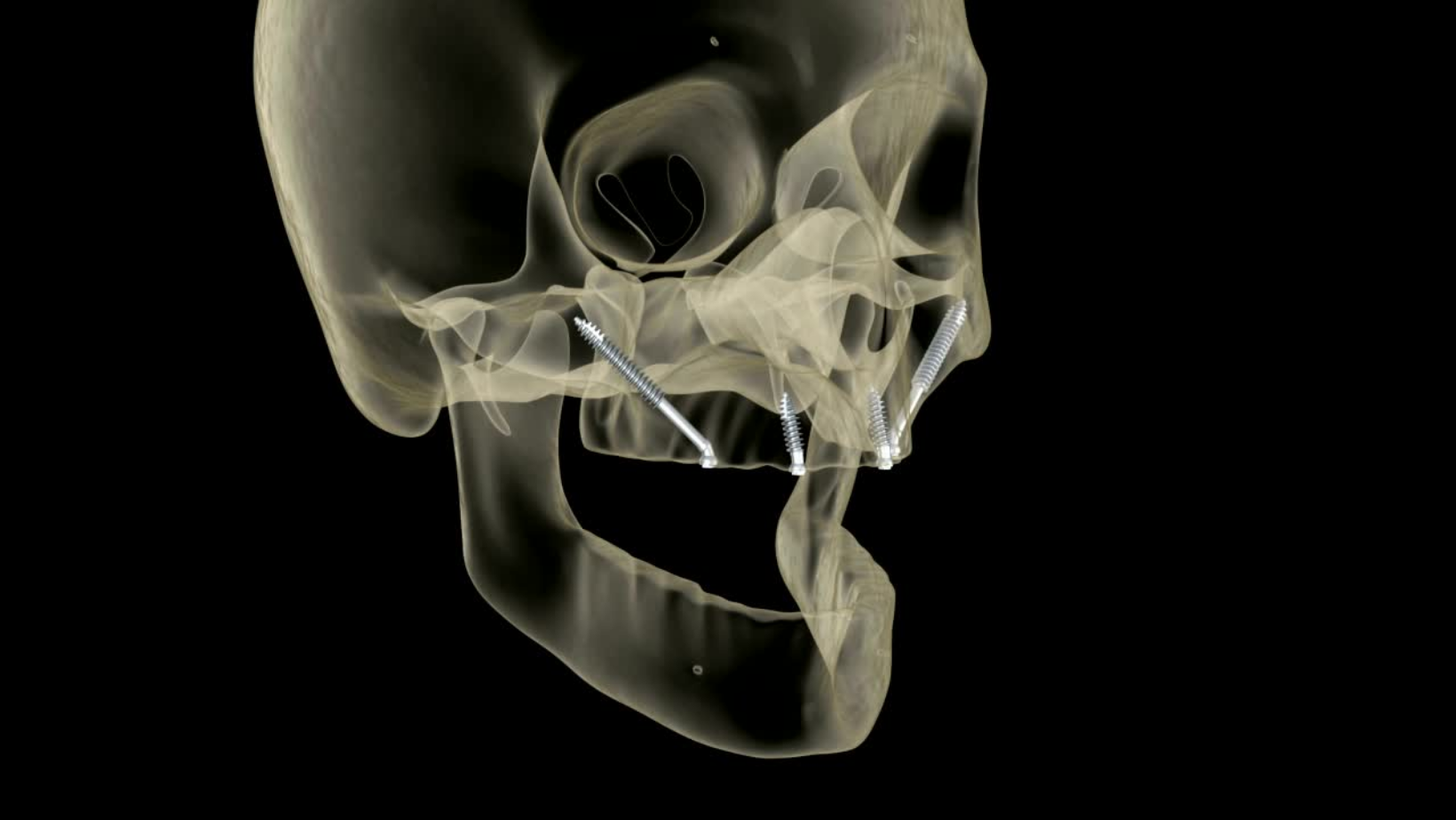 Alternative dental implant placement, zygomatic dental implants