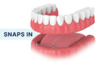 Dentures-SureFit@2x