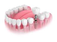 Single & Multiple <br />Dental Implants