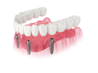 Full Mouth <br />Dental Implants