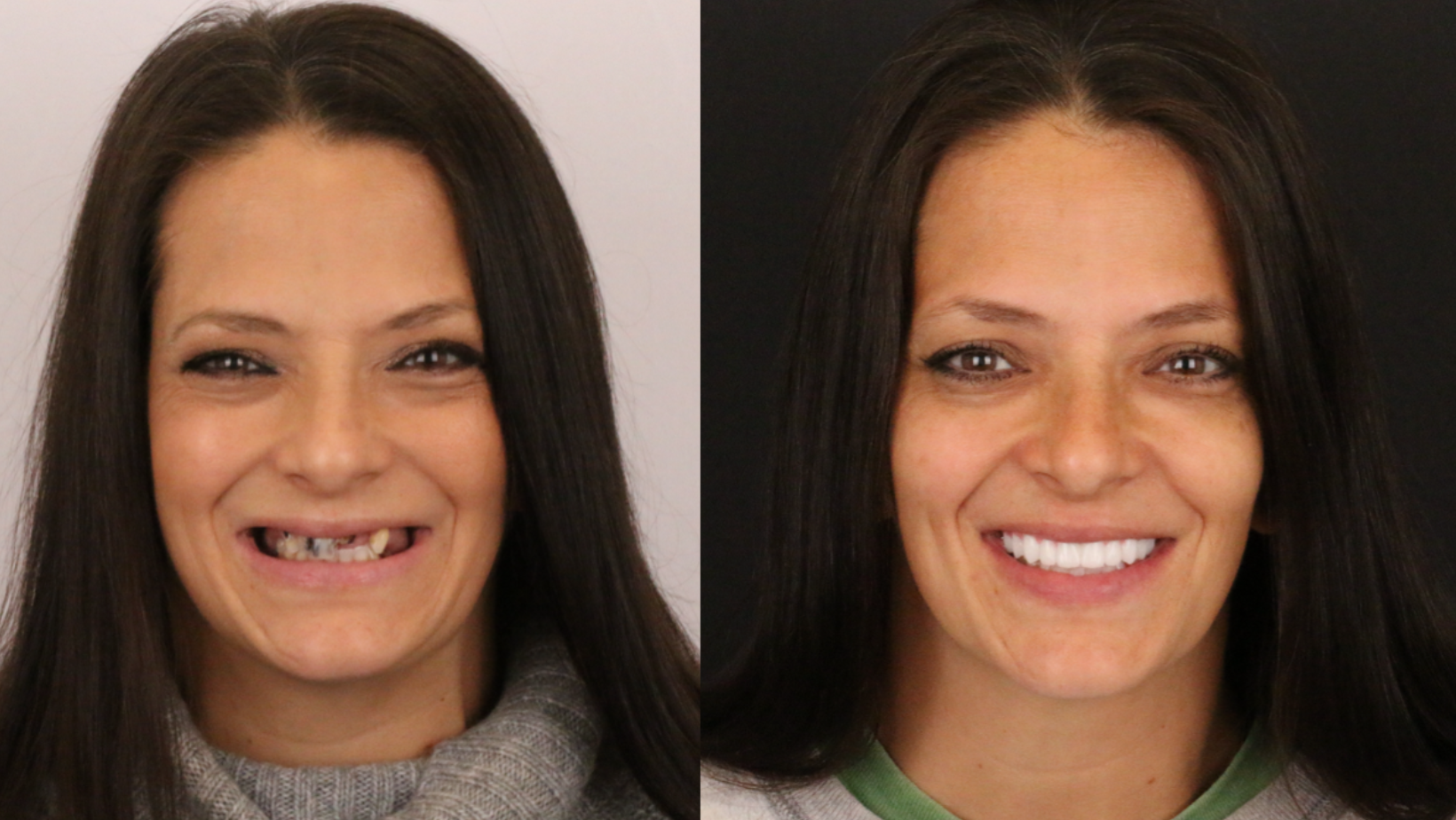 Before and after of a patient who had full mouth dental implants.