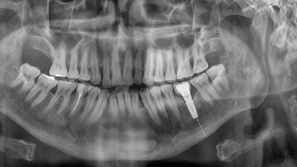 Dental Implants and Bone Health: Keeping Strong Through the Golden Years 